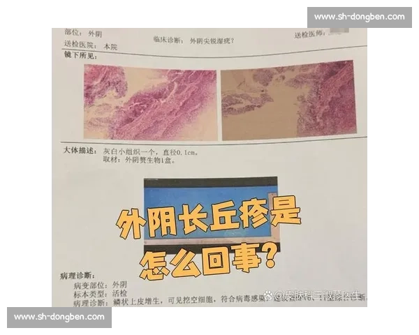 尖锐湿疣的早期症状、诊断方法及有效治疗手段全面解析